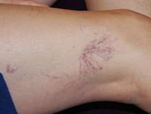 Before spider vein treatment