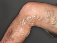 Before varicose vein treatment