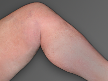 After venous insufficiency treatment